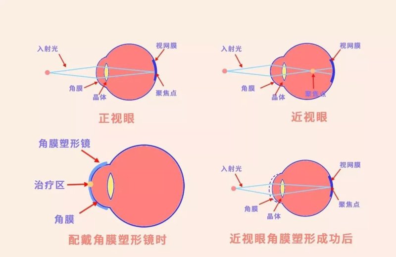 关注视光科技，为您的眼睛打造明亮世界