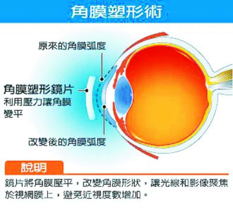 角膜塑形镜